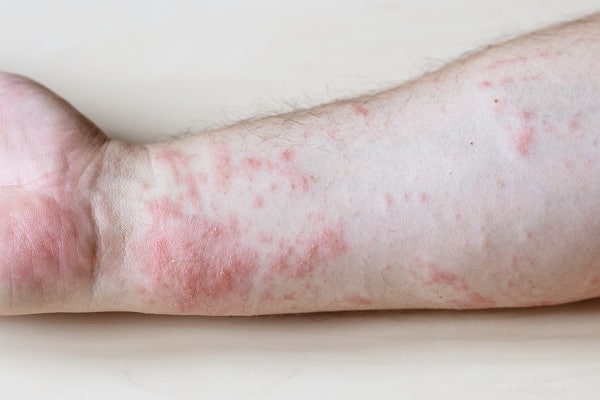 Ringworm